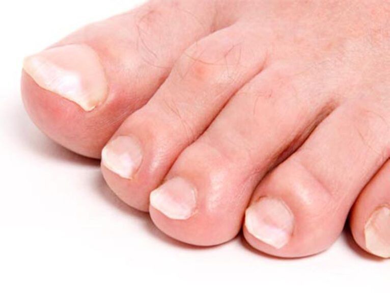 гъбички по ноктите на краката и тяхното лечение