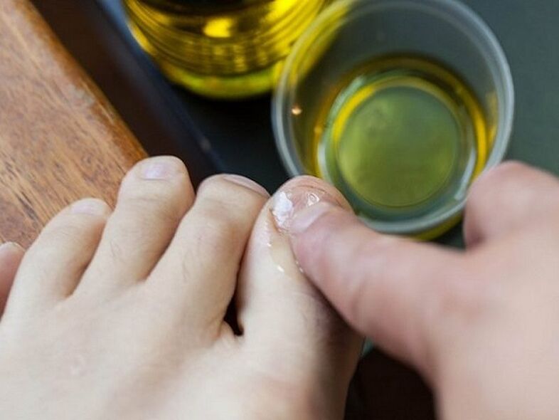 масло от чаено дърво за гъбички по ноктите на краката