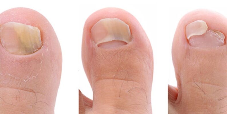 снимка на гъбички по ноктите на краката