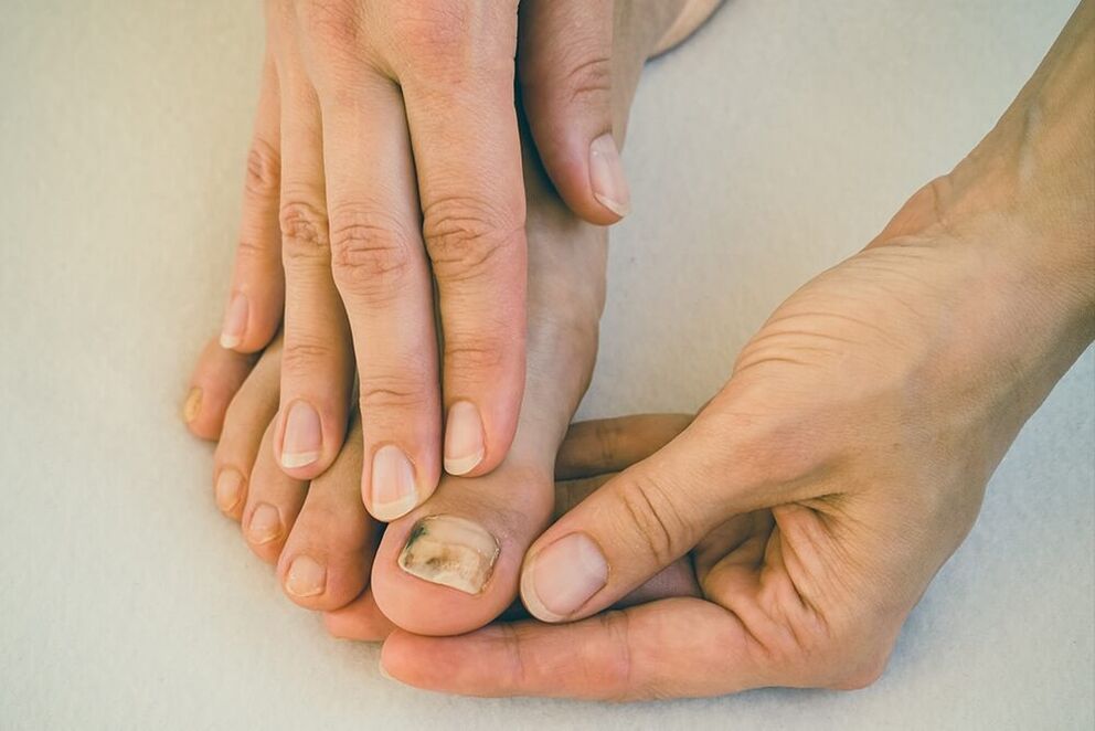 увреждане на нокътната плочка с гъбички